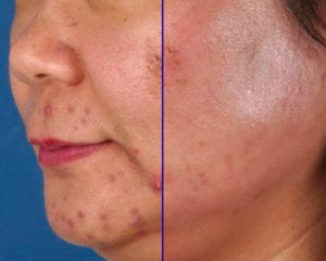 Acne Control - Before and After