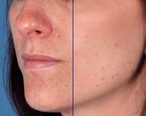 EXFOLIATION ACCELERATOR - Before and After