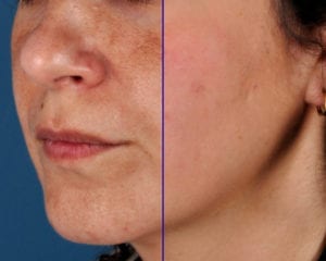 10% VITAMIN C SELF-ACTIVATING - before and after